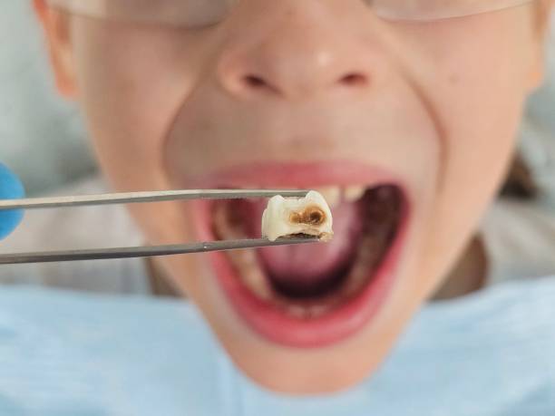Best Emergency Gum Treatment in Santa Ana, CA